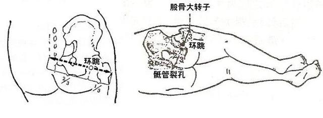 推拿可以調理坐骨神經痛嗎？如何操作？