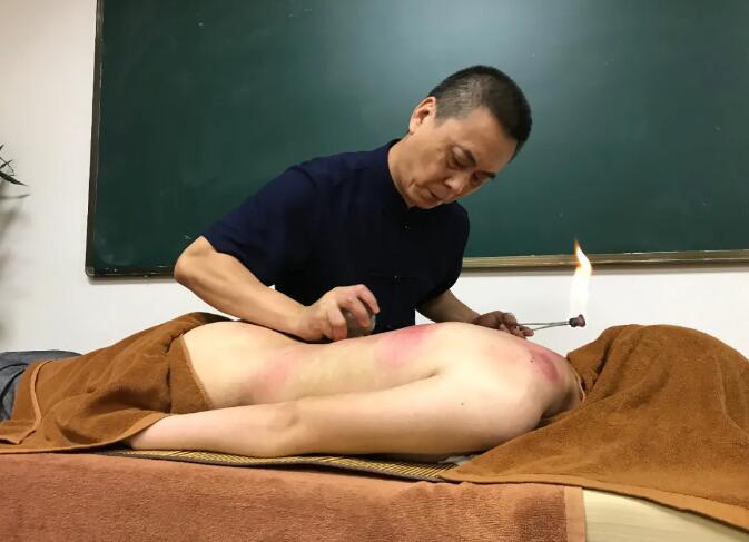腰痛大多和濕邪有關(guān) 中醫(yī)拔罐能祛濕邪