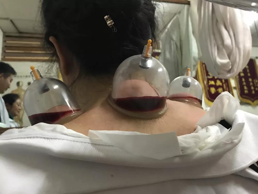 刺血培訓選擇好的學校真的那么難嗎？