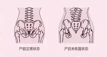 產(chǎn)后修復(fù)培訓(xùn)學(xué)校淺談妊娠紋怎么恢復(fù)