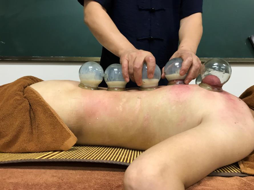 你知道怎么分類拔火罐嗎？中醫培訓學校告訴你