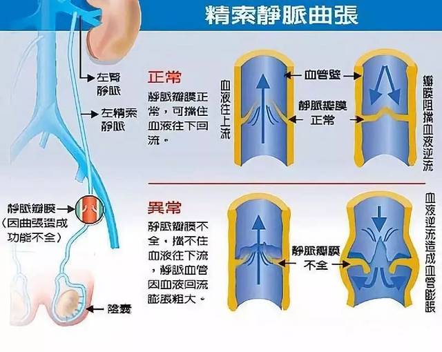 對于精索靜脈曲張 中醫推薦3個療法